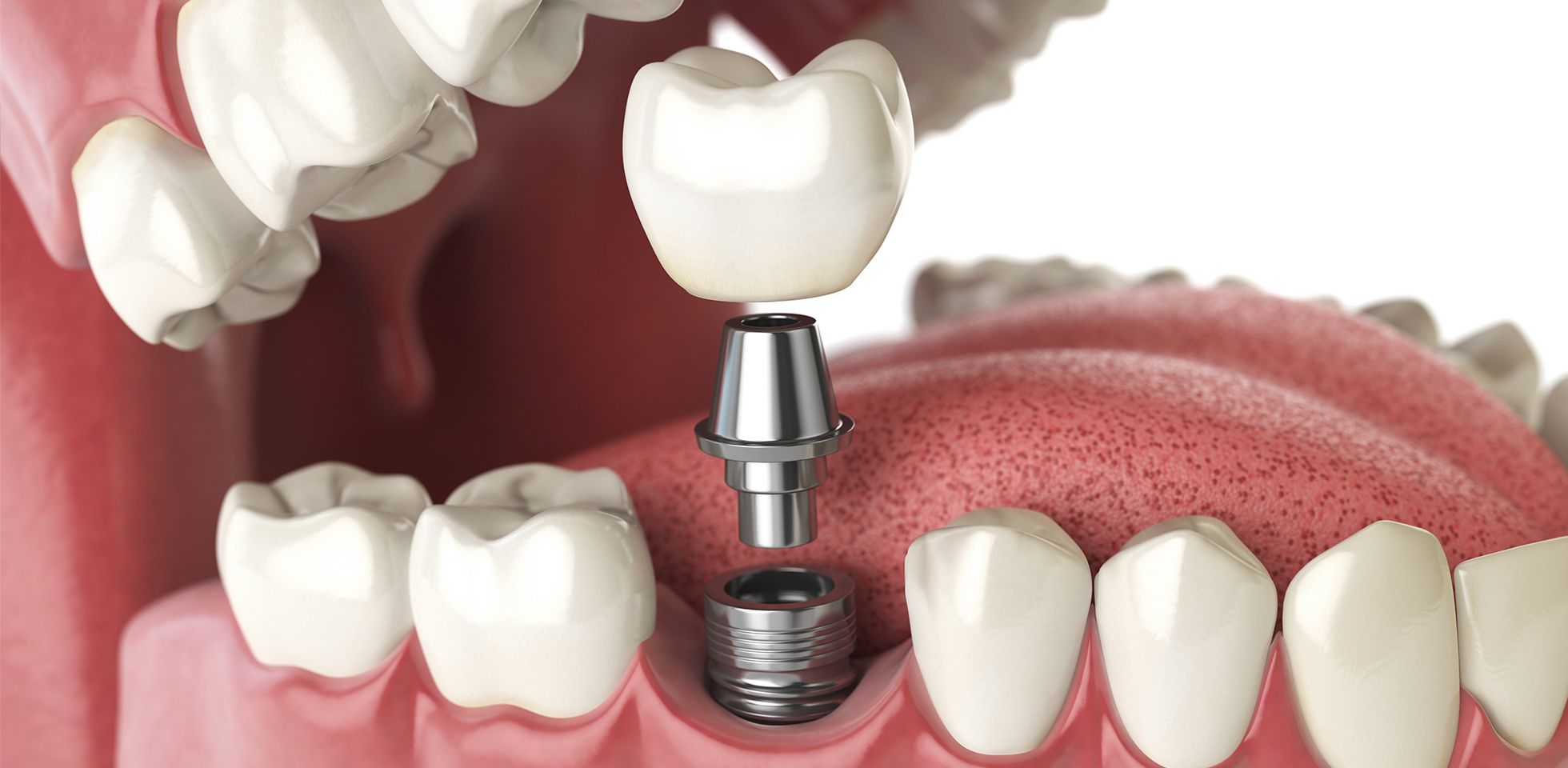 An illustration showing how dental implants are placed near Peterborough